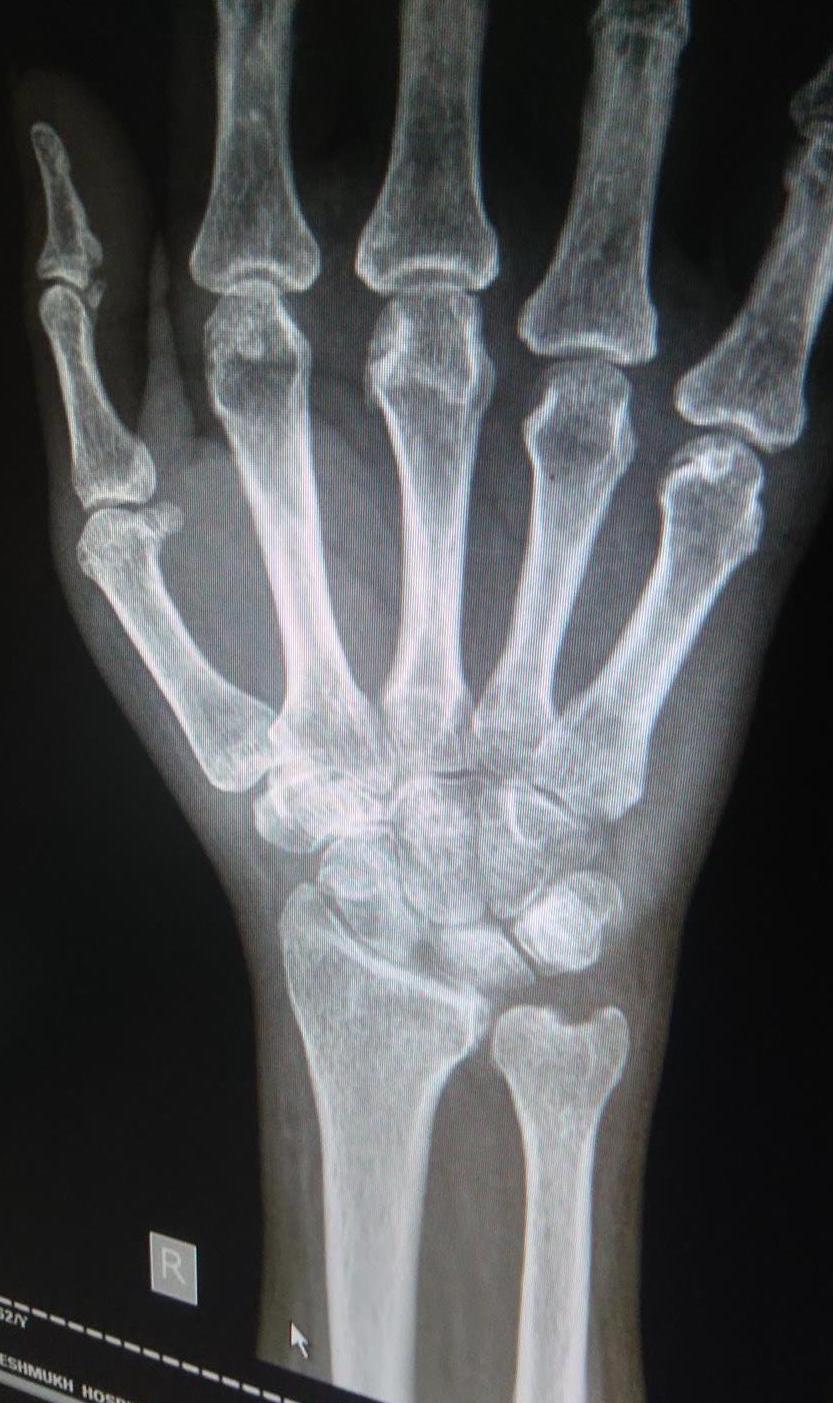 Wrist Arthritis Hand Orthobullets